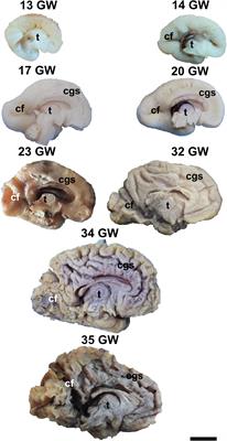 White Matter Dissection of the Fetal Brain